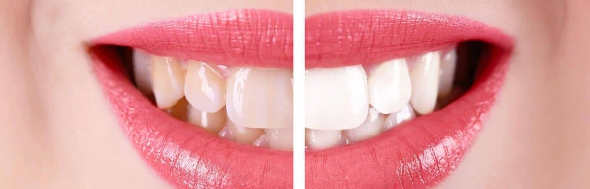 A Guide to the Difference Between Composite and Porcelain Veneers