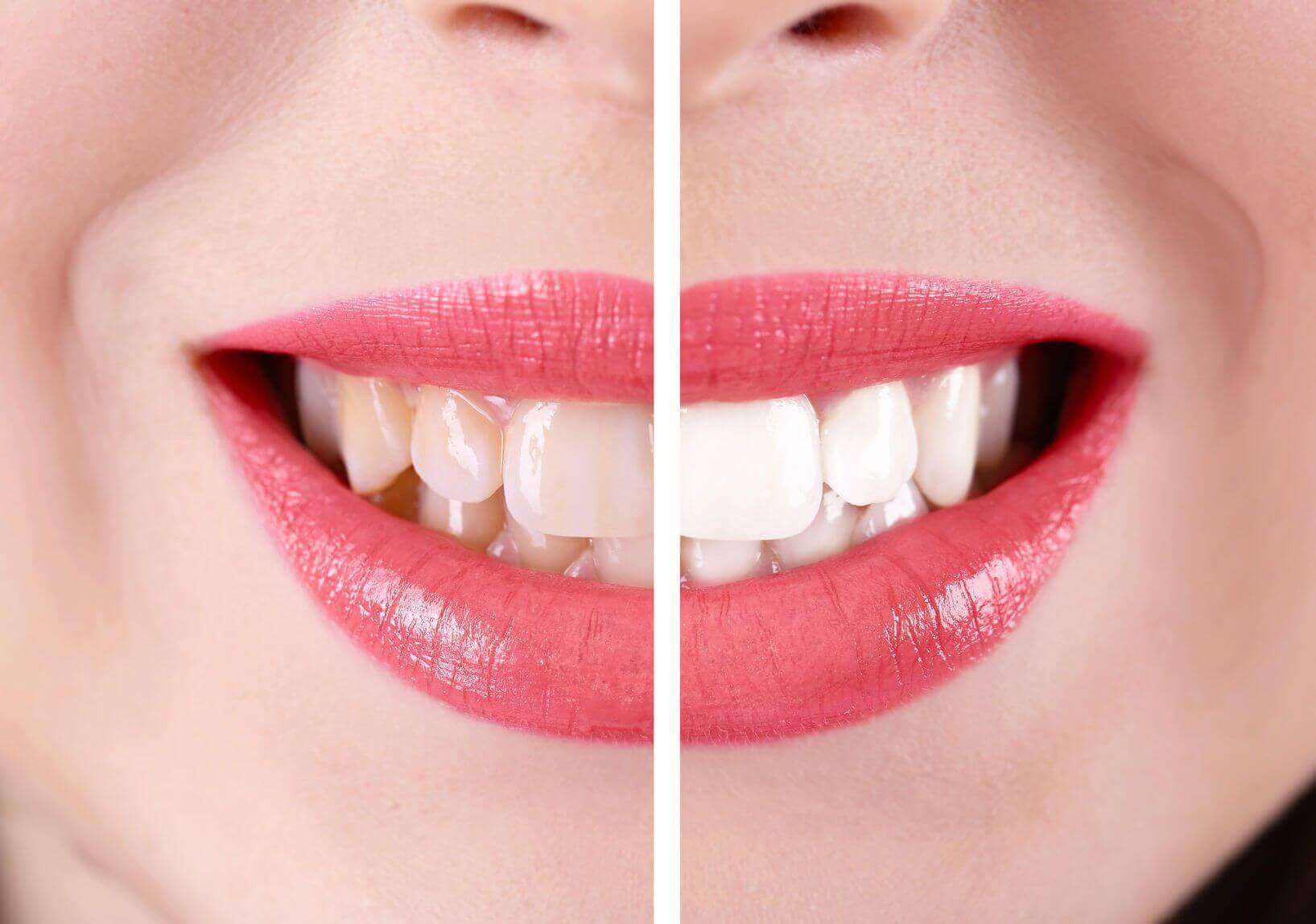 composite and porcelain veneers